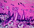 Scabies Infestation (Sarcoptes scabiei)